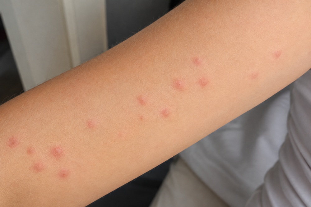 Ronchas compatibles con picaduras de chinches en el brazo